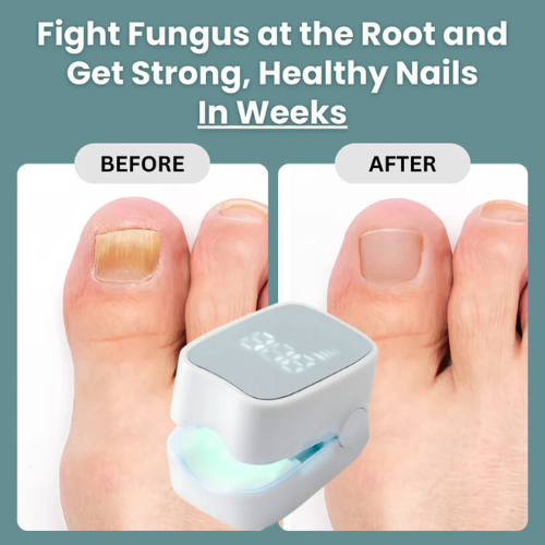 Nail Fungus Laser Device