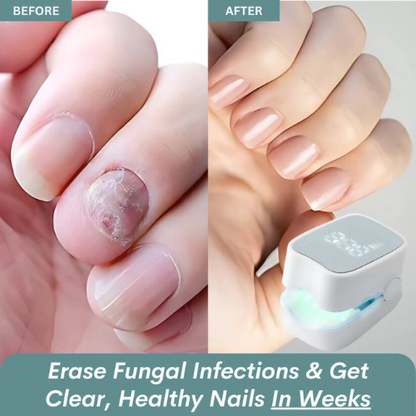 Nail Fungus Laser Device